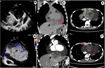 Multimodality imaging assessment of primary pericardial rhabdomyosarcoma: a case report